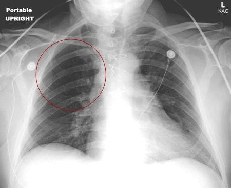 آمبولی ریه در عکس ساده ممکن است به صورت کم خونی ریه دیده شود.