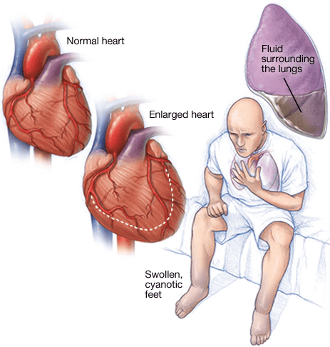 وقتی که عضله قلب نتواند خون را به اندازه کافی پمپ کند نارسایی قلبی رخ می دهد. در نارسایی قلبی علاوه بر عدم تامین احتیاجات بدن، خون پس می زند و باعث تجمع مایعات در ریه ها و پاهاتون می شود و پاها ورم می کند و به خاطر فقدان خون اکسیژنه لبها و ناخنها کبود و سیانوزه می شود. این تجمع مایع در ریه ها باعث تنگی نفس می شود. بعضی از انواع نارسایی قلبی منجر به بزرگ شدن قلب می شود. 