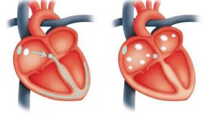 در آریتمی فیبریلاسیون دهلیزی حفرات بالایی قلب بطور نامنظم و هرج و مرج منقبض می شوند.