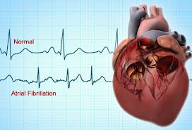 در اریتمی فیبریلاسیو دهلیزی یا نامنظمی قلب ضربان قلب نامنظم است.