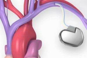 باطری قلب از دو قسمت تشکیل شده یکی ژنراتور و بخش دیگر سیمها یا لیدها هستند.